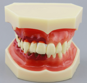 Periodontal Periodontitis Disease Model - My Site